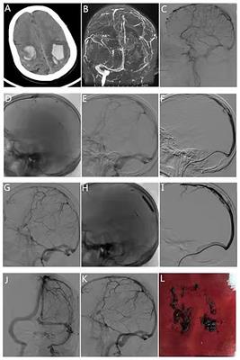 Efficacy of Stent Thrombectomy Alone or Combined With Intermediate Catheter Aspiration for Severe Cerebral Venous Sinus Thrombosis: A Case-Series